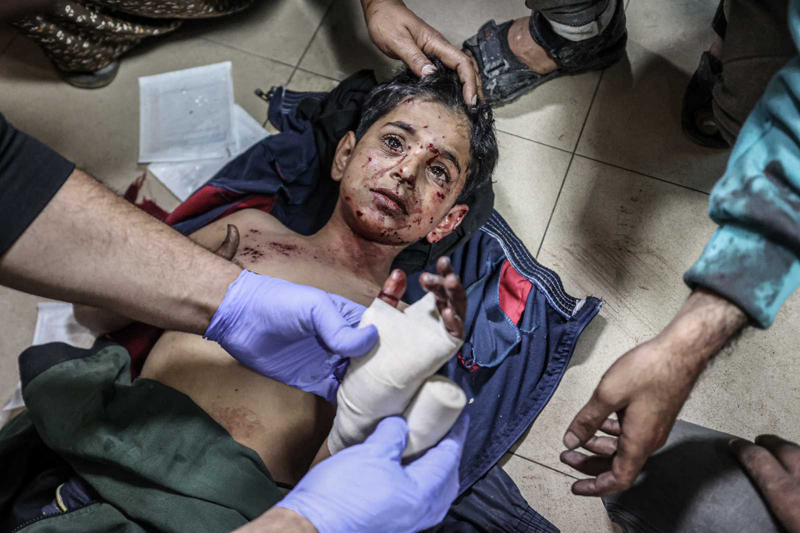 child inured in a bomb strike